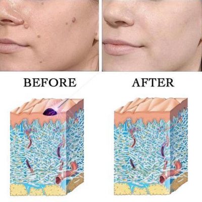 Clear Skin Laser Pen